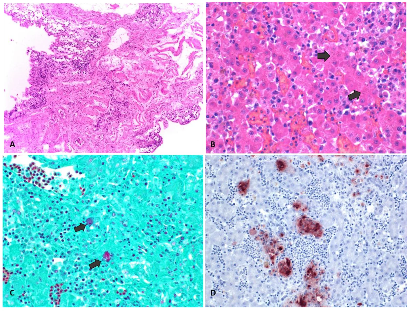Histopatología del mismo brote: aerosaculitis linfoplasmocitaria y necrótica (A), cuerpos elementales en hepatocitos con H-E (B) y con tinción de Gimenez (C), e inmunohistoquímica positiva a Chlamydia en hígado (D).