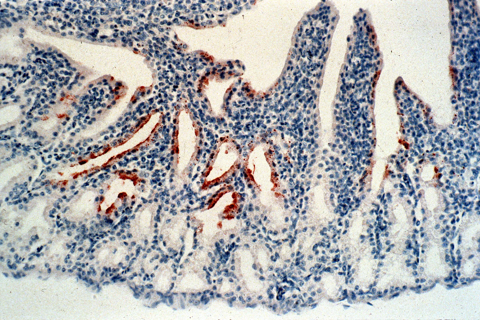Virus de Newcastle virulento en la conjuntiva de una gallina, teñido de café por inmunohistoquímica.