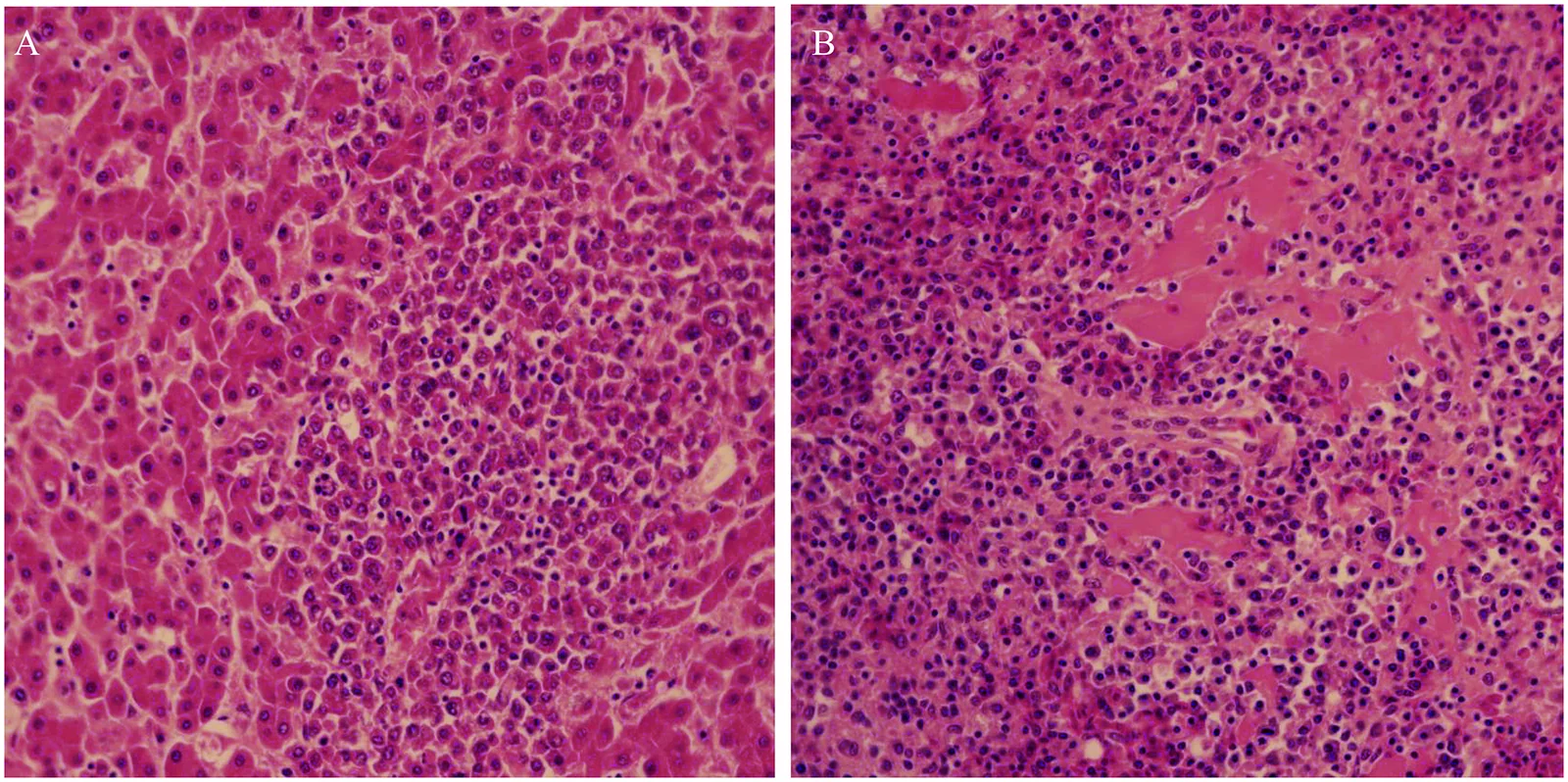 Histopatología de hígado (A) y riñón (B) de reproductoras con ALV-J: infiltración por células mieloides bien diferenciadas.
