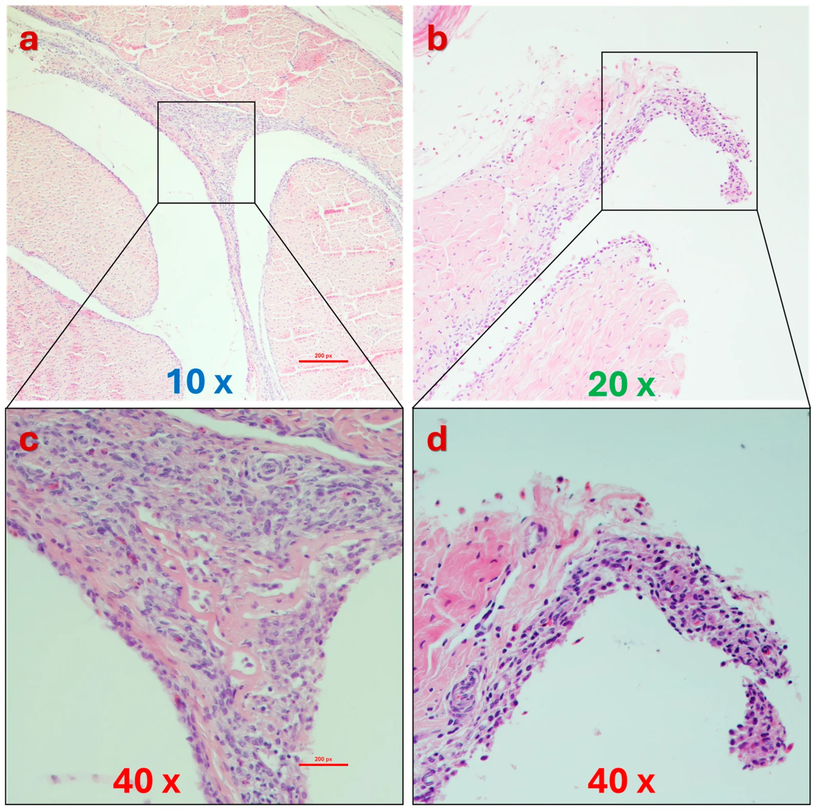 Tendones de pollos de engorde con reovirosis: engrosamiento multifocal de la sinovial con infiltrado de células mononucleares e hiperplasia sinovial (a, b); detalle de las zonas marcadas (c, d).