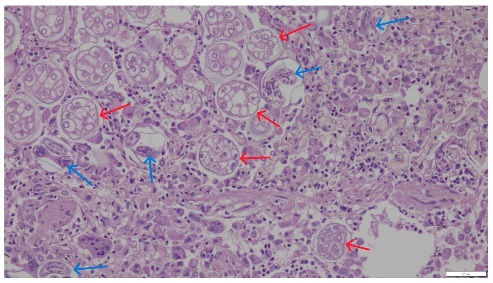 Larvas de primer estadio (flechas azules) y huevos (flechas rojas) de Aelurostrongylus abstrusus en los alvéolos del pulmón de un gato (HE, 200x).