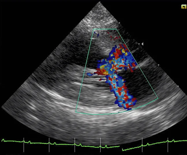Ecocardiografía con Doppler color de un gato doméstico de pelo corto con cardiomiopatía hipertrófica obstructiva. Se ven el tabique engrosado, la obstrucción del tracto de salida del ventrículo izquierdo y la regurgitación mitral.