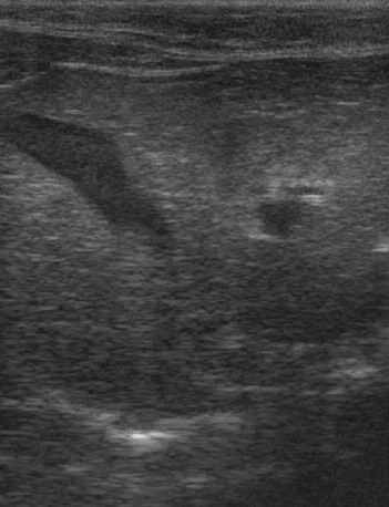 Ecografía de un gato Persa con lipidosis hepática grave. El hígado se ve hiperecogénico, con un brillo parecido al de la grasa que lo rodea.