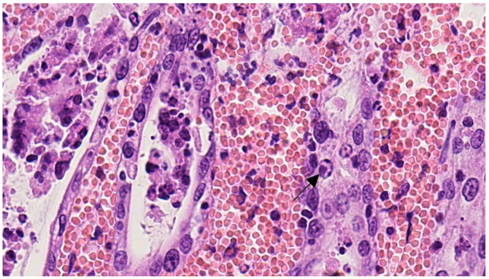 Íleon de un gato con panleucopenia: criptas con células epiteliales que se desprenden y cuerpos de inclusión intranucleares anfófilos (flecha). Hematoxilina-eosina, 400×.