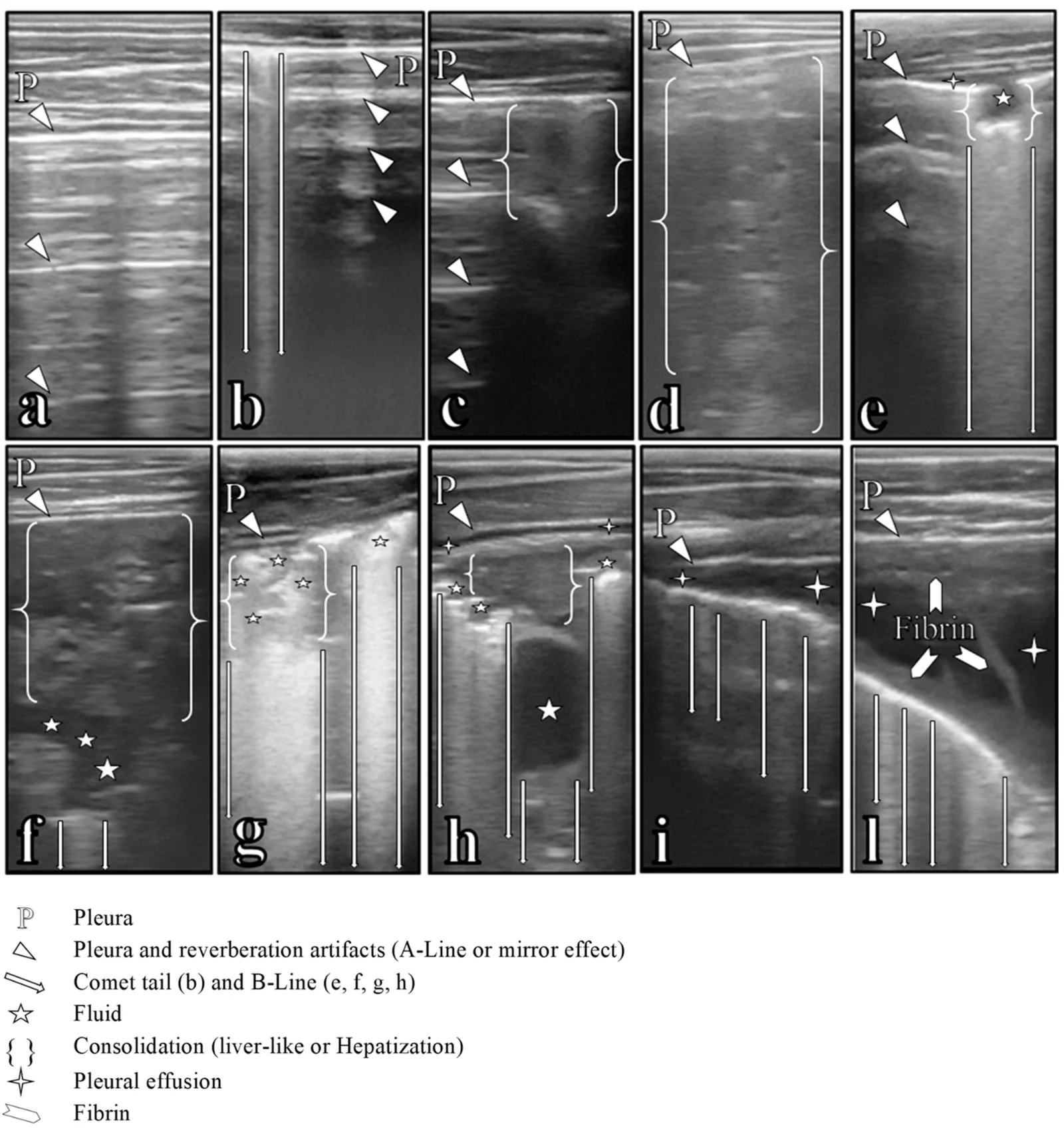 Lesiones ecográficas del pulmón en terneros con complejo respiratorio: pulmón sano (a), colas de cometa (b), hepatización lobulillar y lobar (c, d), broncograma y alveolograma con líneas B y efusión pleural (e a h) y pleuritis moderada y grave con fibrina (i, l).