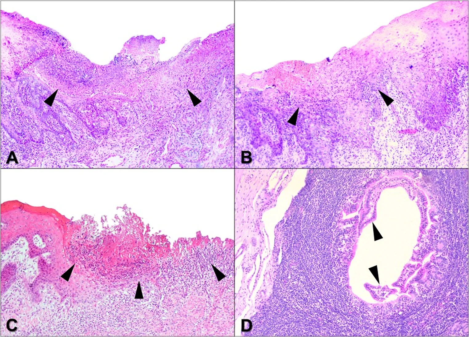 Histopatología de la enfermedad de las mucosas: úlceras de la lengua (A), erosión del esófago (B) y úlcera del rumen (C) con infiltrado inflamatorio mixto, y pérdida de la arquitectura de las placas de Peyer con cavitaciones (D).