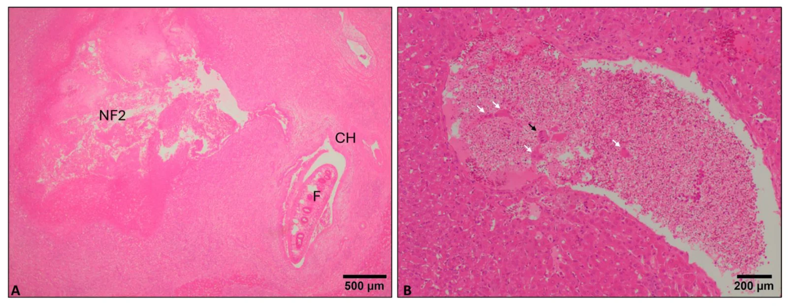 Hígado de ovino infectado con F. hepatica: (A) foco de necrosis junto a un conducto biliar con hiperplasia que contiene una fasciola adulta; (B) émbolo con restos celulares en una vena.