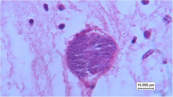 Quiste tisular de Neospora caninum con pared gruesa (flecha) y numerosos bradizoítos en el cerebro de un feto bovino abortado (H&E).