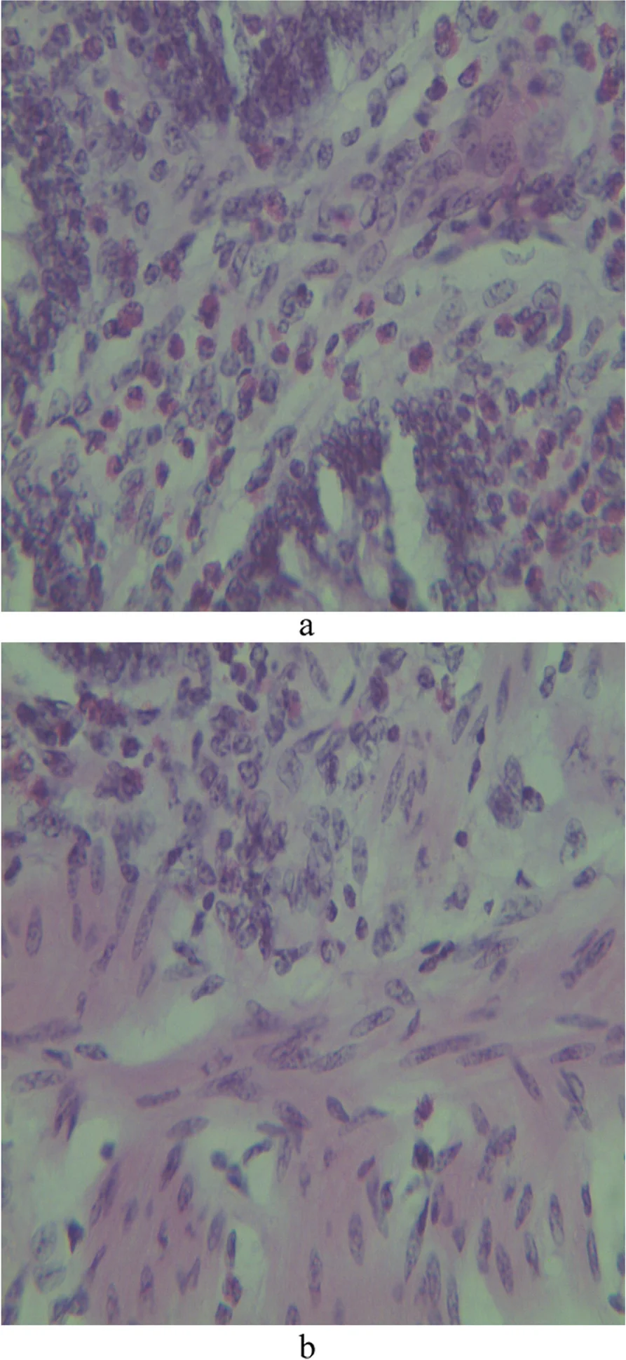 Íleon de un bovino con paratuberculosis: infiltración extensa de células epitelioides en la mucosa (a) y nidos de células epitelioides en la submucosa (b). Hematoxilina y eosina.