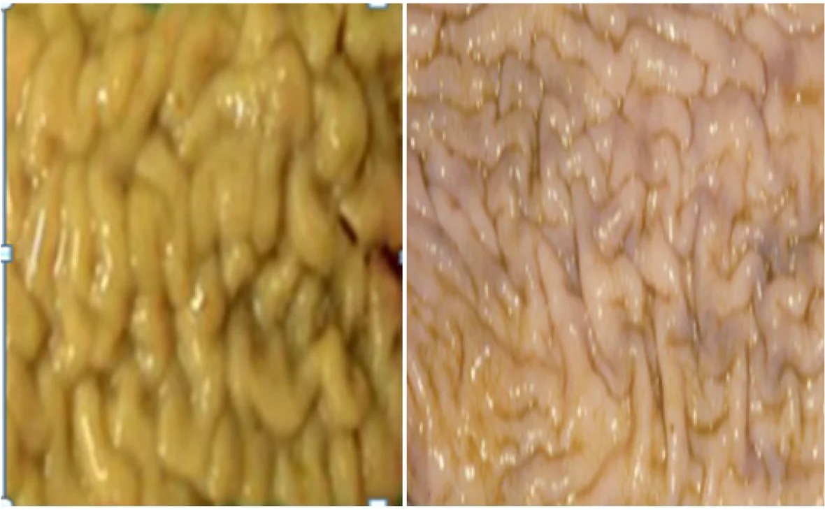 Engrosamiento de la pared y mucosa corrugada del intestino delgado en un bovino con lesiones compatibles con paratuberculosis.