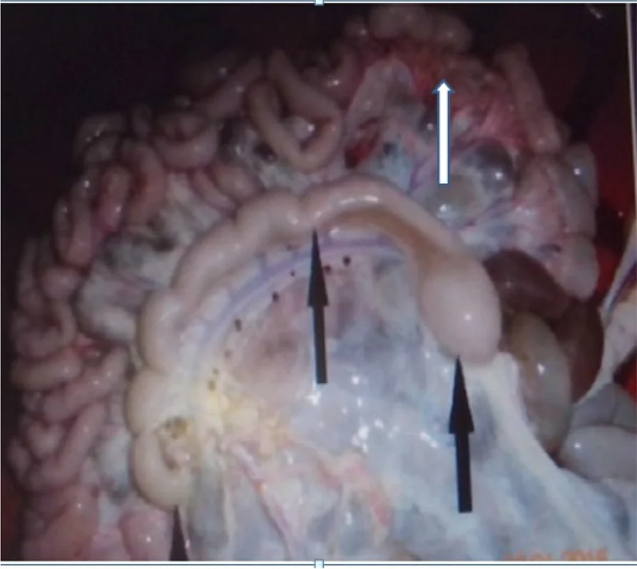Linfonódulos mesentéricos aumentados y edematosos (flecha blanca), con vasos linfáticos engrosados en cordón (flecha negra), en un bovino con lesiones compatibles con paratuberculosis.