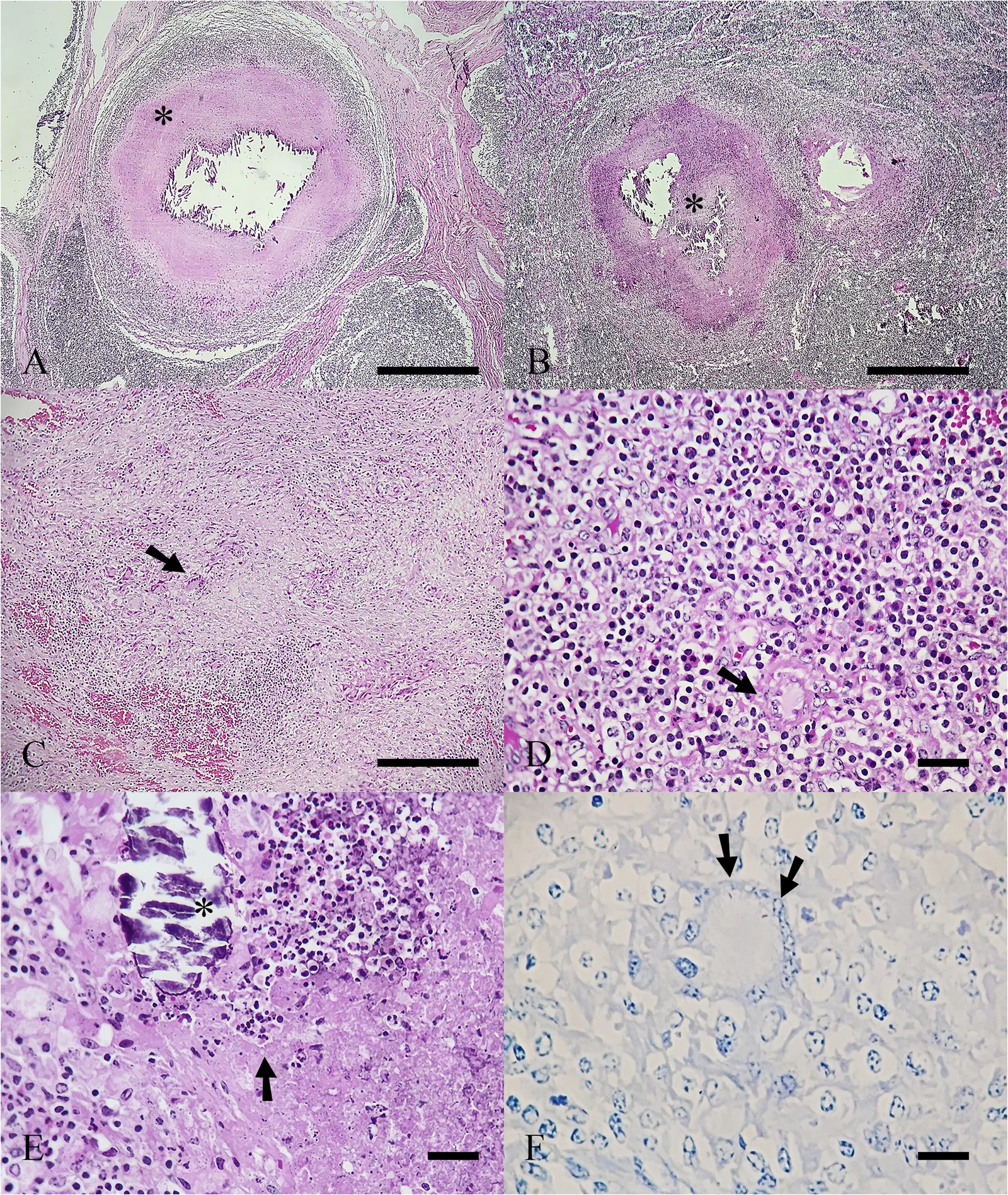 Granulomas tuberculosos en linfonódulos bovinos: patrón clásico encapsulado con necrosis caseosa (A), patrón desorganizado sin cápsula (B), células gigantes de Langhans (C y D), mineralización (E) y bacilos ácido-alcohol resistentes con tinción de Ziehl-Neelsen (F).