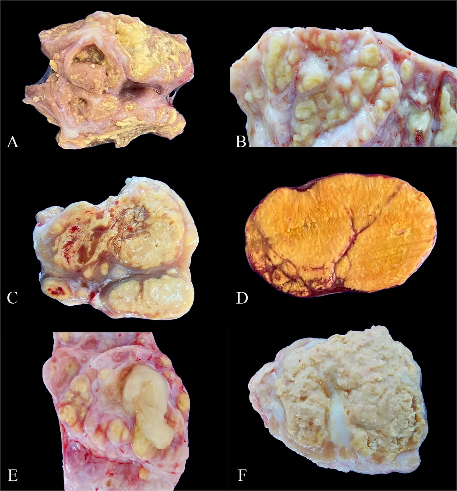 Lesiones macroscópicas en linfonódulos de bovinos con tuberculosis: desde focos caseosos amarillentos bien delimitados (A) hasta reemplazo completo del linfonódulo (D) y material purulento (E).