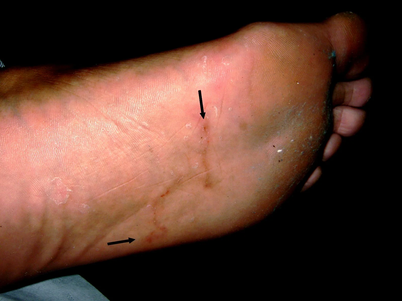 Larva migrans cutánea en la planta del pie de una persona: la lesión serpenteante marca el recorrido de una larva de anquilostoma animal bajo la piel. Las flechas indican los extremos de la lesión.