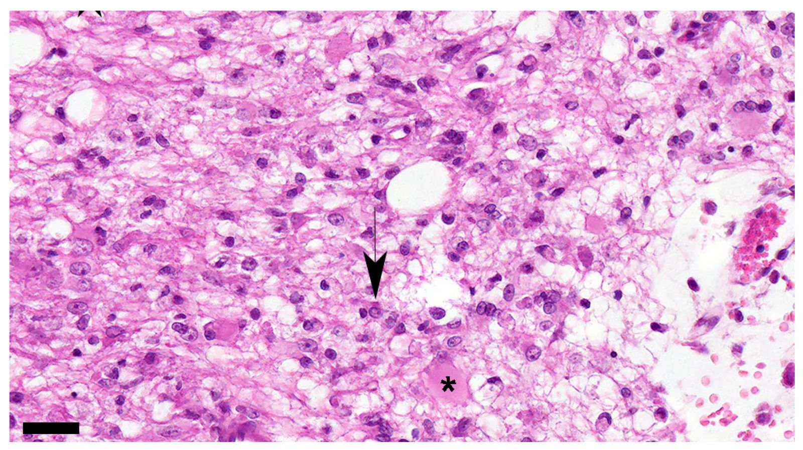 Sustancia blanca del cerebelo de un perro con distemper en fase subaguda: desmielinización con astrocitos aumentados de tamaño (gemistocitos, asterisco), células multinucleadas y cuerpos de inclusión nucleares (flecha). Hematoxilina-eosina, barra 30 µm.
