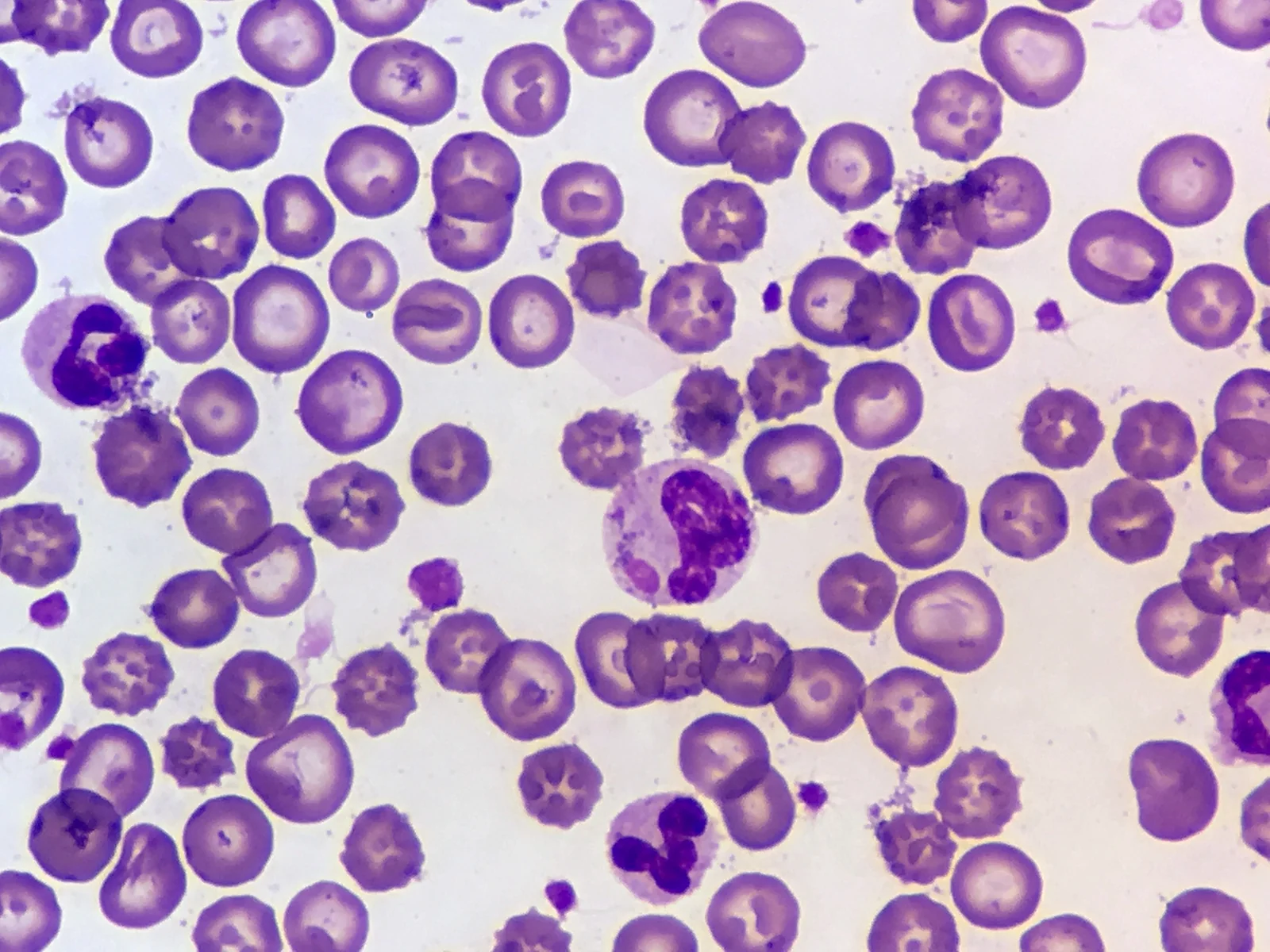 Cuerpo de inclusión citoplasmático del virus del distemper (corpúsculo de Lentz) en un neutrófilo, en el frotis sanguíneo de una cachorra de un mes con signos respiratorios y conjuntivitis. Tinción de Wright.